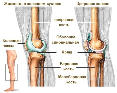 Жидкость в коленном суставе? Смотрите простейший способ избавиться от нее