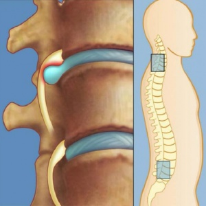 Лечение межпозвоночной грыжи без лекарств и операции: упражнения для спины от Шамиля Аляутдинова